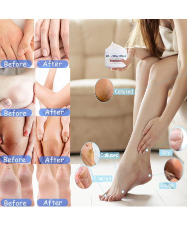 Deep Moisturizing Urea Foot Cream for Cracked Heels - 40% Urea Formula for Dry Skin, Callus Remover, Nourishes & Softens Feet, Knees, and Hands - Buy Online on GoSupps.com