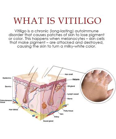 Vitiligo Treatment Spray - Skin Pigmentation Care & White Spot Reduction (2pcs) - Buy Online on GoSupps.com