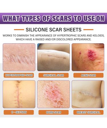 Silicone Scar Sheets & Tape | Effective Scar Removal for Surgical & Keloid Scars - 1.6 x 59 Roll (1.5M) - Fast International Shipping - Buy Online on GoSupps.com