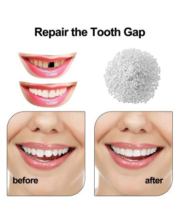 Teeth Repair Kit - Moldable False Teeth Thermal Fitting Beads (25g) - Buy Online on GoSupps.com