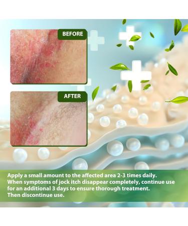 Cr me antifongique pour la mycose de l aine et du pied: Traitement Naturel contre le Pied d Athl te les D mangeaisons du Jock la Teigne et l Ecz ma 30g 30 g (Lot de 1) - Buy Online on GoSupps.com