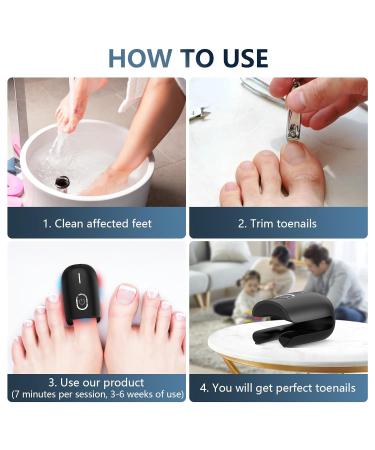 Ikeen Nail Fungus Treatment Device - Effective Onychomycosis Relief with Red & Blue Light Painless & Fast Fuzspilz Solution for Healthy Nails - Buy Online on GoSupps.com