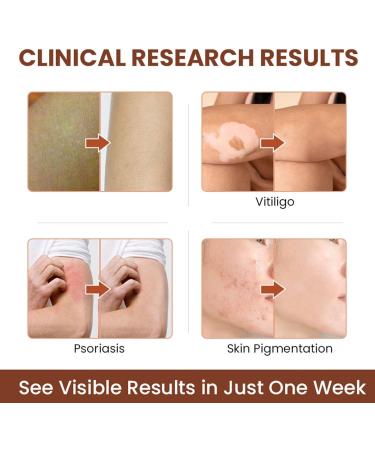  Hongjingda Skin lightening cream for vitiligo - 20g vitiligo relief cream for white patches on the skin reduces white patches improves epidermal melanocytes Hongjingda - Buy Online on GoSupps.com