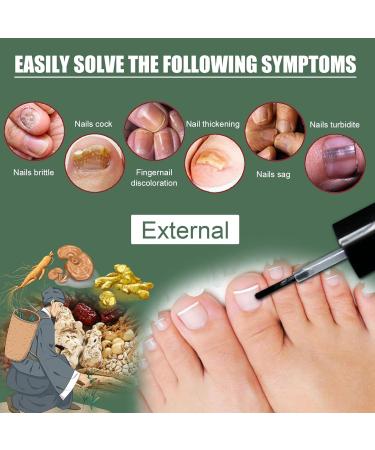 Keratin 3 Day Growth Nail Treatment & Strengthener Nail Strengthener for Damaged Nails Extra Strong Nail Growth Treatment Nail Repair Treatment Nail Strengthener and Growth Polish Nail Growth Serum - Buy Online on GoSupps.com