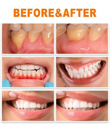 2 Piece Gum Repair Treatment - Effective Ampoules for Receding Gums & Oral Health - Buy Online on GoSupps.com