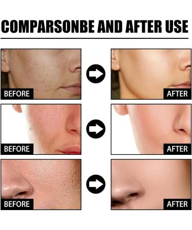 Sunnylas Niacinamide Freckles Removal Serum Niacinamide Spots Removal Serum Nicotinamide Serum for Blemishes Hydrating and Moisturizing Facial Essence (2 PCS) - Buy Online on GoSupps.com
