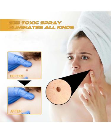 Shop Tag Recede Bienengift & Wart Removal Spray Effective Skin Treatment for All | International Shipping - Buy Online on GoSupps.com