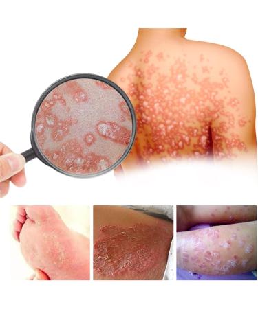 KRRHUEO Bee Venom Psoriasis Treatment Cream - Soothing and Moisturizing Skin Relief (1PCS) - Buy Online on GoSupps.com