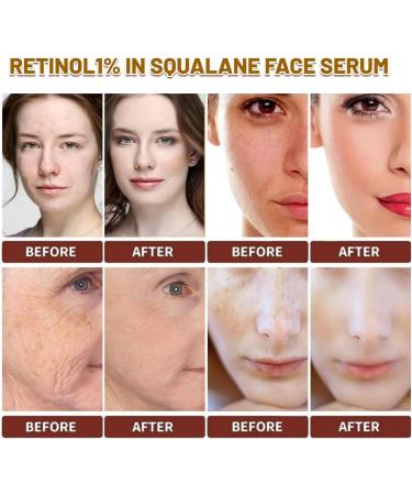 Retinol1% In Squalane Retinol Serum For Face Retinol Serum High-Strength Face Serum for Women Anti-Aging Face Serum Fade Fine Lines Acne Reduced Skin Brightening Face Serums For Skin Care - Buy Online on GoSupps.com