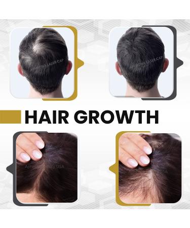 Aphrona Advanced Hair Growth System 272 HairPro - Rechargeable Laser Cap for Hair Regrowth | Clinically Proven, FDA Cleared | Mild to Moderate Hair Loss Solution for Men and Women - Buy Online on GoSupps.com