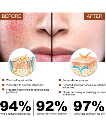 Rosacea Face Serum Anti Redness Face Serum for Women Relieve Redness & Acne Mark Dark Spot Correcting Glow Serum Anti Aging Serum for Face Hydrating Face Serum Skin Care for Women Dark Spots Remover - Buy Online on GoSupps.com