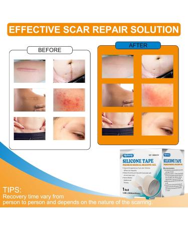 Silicone Scar Sheets & Gel Tape Roll - Reusable Waterproof Scar Removal for C-Section Keloid & Stretch Marks - 1.6 x 59 - Buy Online on GoSupps.com