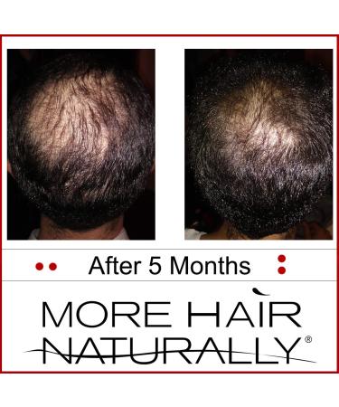 More Hair Naturally 9 - Advanced Stem Cell Therapy for Thinning Hair - Buy Online on GoSupps.com