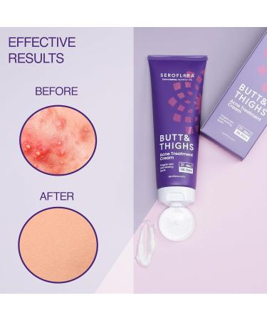 Butt Acne Cream & Razor Bump Serum Helps Reduce the Look of Ingrown Hairs, Bumps & Redness Post-Shave & Waxing Skin Comfort - Bundle - Buy Online on GoSupps.com