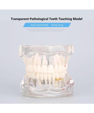 Buy Dental Diseases Teaching Study Adult Typodont Model - Realistic Tooth Demonstration for Education | International Shipping Available - Buy Online on GoSupps.com