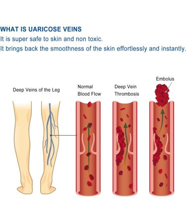 50g Natural Varicose Veins Cream | Leg Circulation & Spider Vein Remover | Cooling Effect | Ointment - Buy Online on GoSupps.com