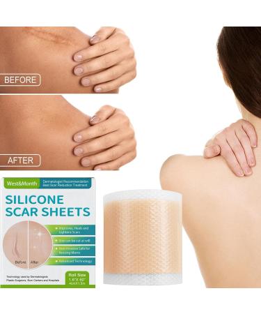 Teksome Scar Tape for Body - 1.5m Stretch Mark Remover Strips | Silicone Gel Tape for Scars & Stretch Marks - Buy Online on GoSupps.com