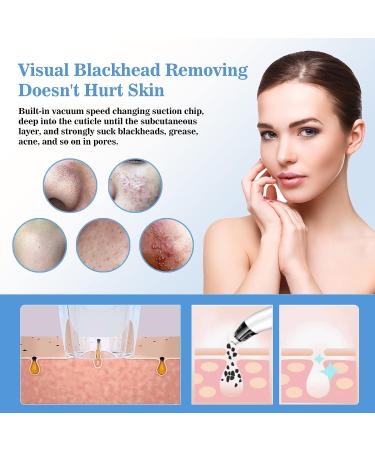 Hohotti Blackhead Remover Vacuum with Camera | USB Rechargeable Pore Vacuum for Face | 6 Suction Heads & 5 Modes | Acne Extractor Tool Kit - Buy Online on GoSupps.com