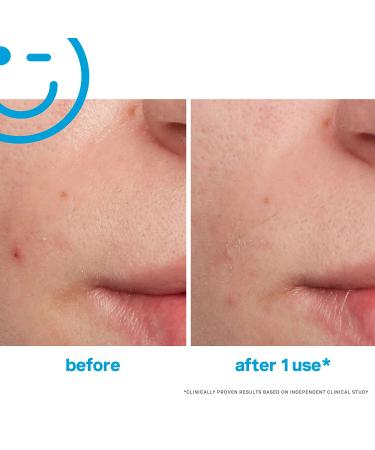 Kate Somerville EradiKate Acne Treatment - 10% Sulfur & BHA Spot Treatment for Clear Skin, 1 Fl Oz - Buy Online on GoSupps.com