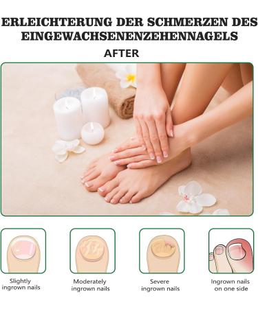 Ingrown Toenails Set of 24 Nail Clips Toenails Pull Ointment Set for Ingrown Toenails Orthopaedic Pedicure Tool with Nail Clippers Nail Clippers and Tweezers - Buy Online on GoSupps.com