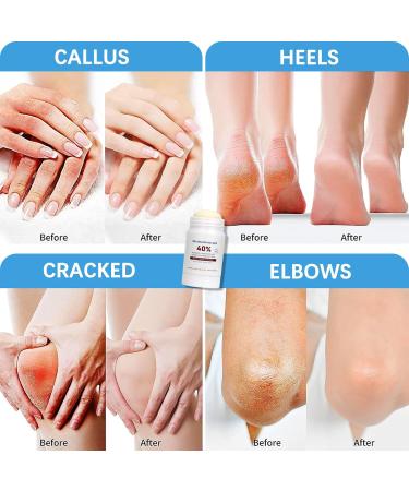 Urea 40% Foot Cream Urea Foot Cream for Cracked Heels and Dry Skin Moisturizing Cracked Heel Repair Cream Stick Nourishing Callus Remover and Soften for Hand Foot Skin Care - Buy Online on GoSupps.com