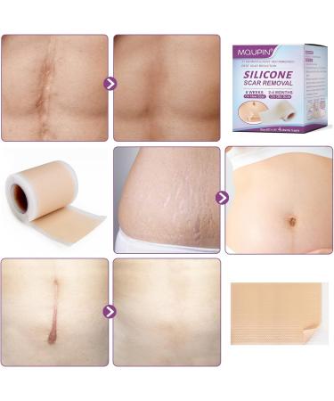 MQUPIN Silicone Scar Tape Roll (1.6 x 60 ) Silicone Scar Sheets Silicone Tape Reusable for C-Section Surgical Scar Keloid Acne Scar and Burn Scar - Buy Online on GoSupps.com