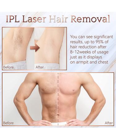 Aopvui At-Home IPL Hair Removal - Permanent Laser Hair Removal with 999900 Flashes for Women and Men - Facial Legs Arms Whole Body Treatment - Buy Online on GoSupps.com