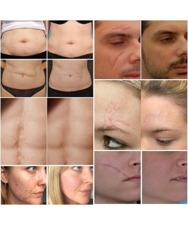 Aliver Scar Removal Cream - Stretch Mark & Acne Remover for Men & Women - Effective Treatment for Old & New Scars, Cuts, and Keloids - Buy Online on GoSupps.com
