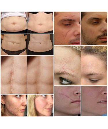 Scar Removal Cream for Old Scars, Stretch Marks & Burns - Natural Skin Repair for Acne Scars & Spots - Buy Online on GoSupps.com
