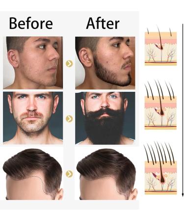 Hair Growth Serum 0.5MM Beard Derma Roller Natural Hair Density Essential Oil Ginger Hair Oil for Hair Rapid Growth and Thickening Gifts for Men and Women - Buy Online on GoSupps.com