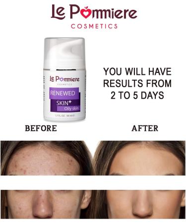 Le Pommiere Acne Treatment Gel 50ml Helps Remove Pimples Acne from Face or Body Anti-Facial and Body Impurities Youth Young Hormonal or Cystic - Buy Online on GoSupps.com