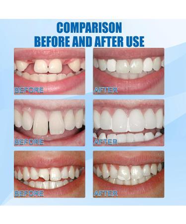 XIRUJNFD Tooth Repair Granules Temporary Tooth Repair Kit Temporary Tooth Filling Kit Tooth Repair Granules Kit Temporary Tooth for Everyone 2Pcs - Buy Online on GoSupps.com