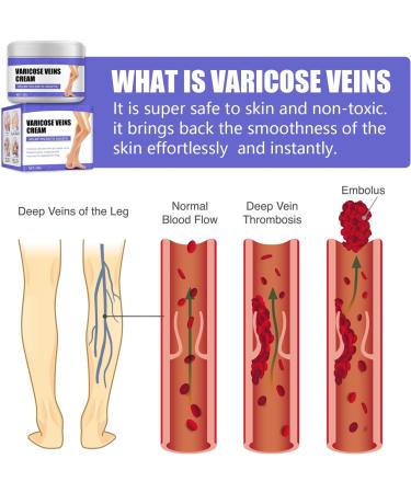 Varicose Veins Cream - Herbal Ointment for Leg Fatigue - Improve Circulation and Eliminate Spider Veins (30g) - Buy Online on GoSupps.com