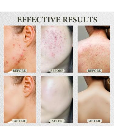 Organic Acne & Redness Relief Set Organic Acne & Redness Killer Balm Natural Clearing Balm for Face Soothing Breakout Control & Skin Repair Kit for All Skin Types 4PCS 4 Fl Oz (Pack of 1) - Buy Online on GoSupps.com