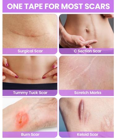 Silicone Scar Sheets - Medical Grade 1.6 x 120 Roll for Surgical Scars Keloids & C-Section Recovery - Non-Irritating Scar Removal Strips - Buy Online on GoSupps.com