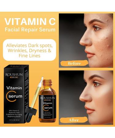 Derma Roller Kit for Face and Body - Vitamin C 20% Serum Skin Care Kit 540 Microneedling Face Roller 0.5mm Vitamin C E Hyaluronic Acid Serum Microneedle Roller Set for Acne Scar Anti Aging Wrinkles 2 Piece Set - Buy Online on GoSupps.com