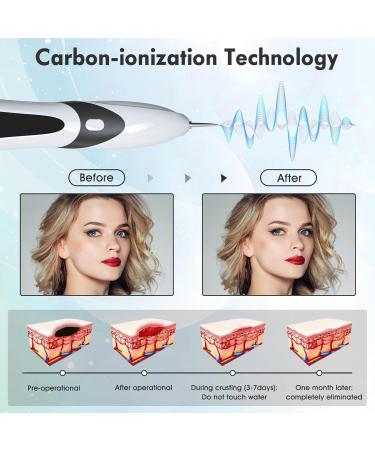 Aceshop Skin Tags Removal Pen Professional Mole Remover Pen Kit with 9 Strength Levels & Replaceable Needles USB Rechargeable Mole Remover Pen Kit Plasma Pen for Wart Freckle Nevus (White) - Buy Online on GoSupps.com