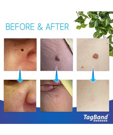 TagBand Original Tagband Skin Tag Remover Device Includes 10X Bands Home Application in Minutes 2mm 4mm - Small & Medium - Buy Online on GoSupps.com