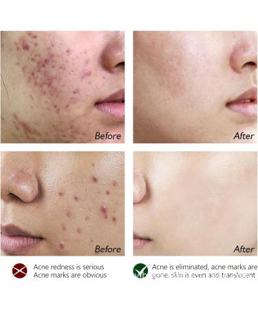 Rosarden Anti Acne Serum for Face Natural Herbal Face Serum for Improvement Pimples Pore Acne Scar Anti Pimple Serum Face Care for All Skin Types of Acne - Buy Online on GoSupps.com