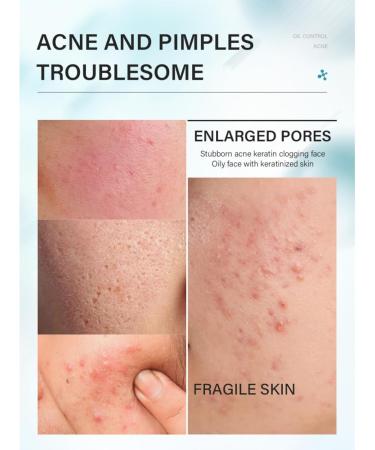 Tea Tree Acne Skin Care Kit for Oily Skin 4 Step Acne Treatment Refreshing Oil Control Nourishes Skin Travel Size with Face Cleanser - Buy Online on GoSupps.com