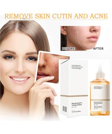 Mikabila (03) Glycolic Acid 7% Toning Resurfacing Solution 240ml Glycolic Acid Toner for Large Pores & Acne Skin Resurfacing Solution Exfoliating Hydrating Toning Solution Repair Acne Skin Toner - Buy Online on GoSupps.com