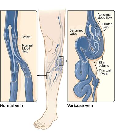 Diosmin Leg Vein Support Supplement - 90 Capsules - Circulation Vein & Varicose Vein Treatment - Buy Online on GoSupps.com