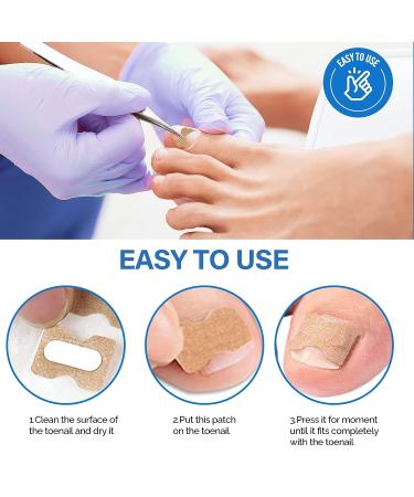 Ingrown Toenail Treatment Kit - 50Pcs No Glue Corrector Patch & Tools - Protect and Repair Ingrown Nails - Buy Online on GoSupps.com