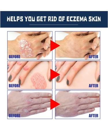 Pofeiya Eczema Therapy Spray - Fast Relief from Itching & Dry Skin - All Natural Formula - 3Pcs - Buy Online on GoSupps.com