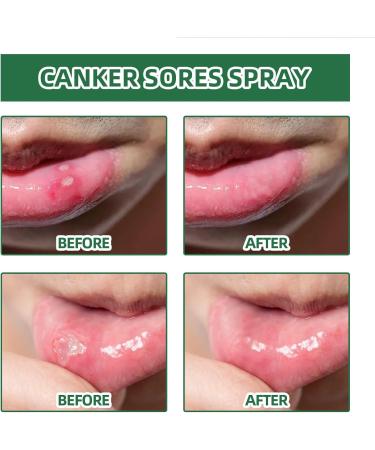 Spray de Soulagement Ulc res Buccaux Spray de Soulagement Ulc res Spray Ulc res de la Bouche 20ML Aphtes Buccaux Gonflement des Gencives Rafra chissant Soins Aphrodisiaques - Buy Online on GoSupps.com
