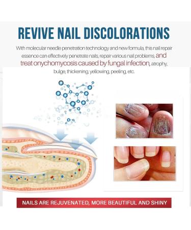 Fungal Nail Treatment Premium Fungal Nail Eliminator Toenail Treatment Extra Strong Nail Repair Anti fungus Nail Repair and Strengthen Fix & Renew Damaged Broken Nails - Buy Online on GoSupps.com