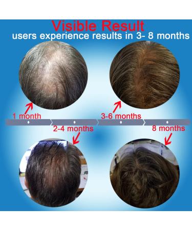 CLETINA Laser Hair Growth System - Red Light and Laser Therapy for Hair Regrowth - Ideal Treatment for Thinning Hair - Buy Online on GoSupps.com