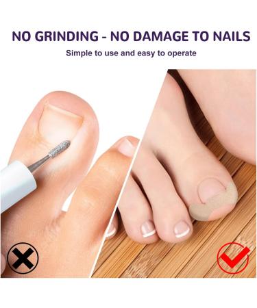 Grgowe Nail Correction Ingrown Toenail Corrector Foot Toenail Plasters Foot Correction Foot Toenail Correction for Care of Toenail Treatment Protect - Buy Online on GoSupps.com