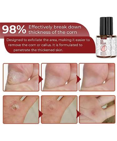 Gfouk Foot Corn Removal Gel 10ml - Extra Strength Liquid Treatment (3Pcs) - Buy Online on GoSupps.com