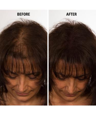 Infinity Hair Fibers - Thicker Fuller Hair for Men & Women | 14g Medium Brown | Conceal Thin Hair Effortlessly - Buy Online on GoSupps.com